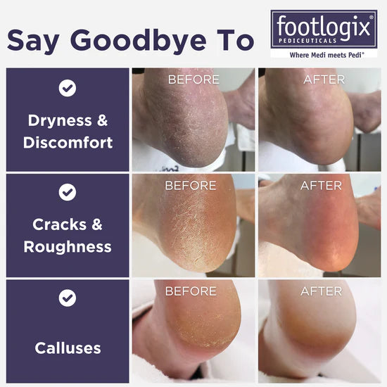 Foot Logix - Callus Softener and File