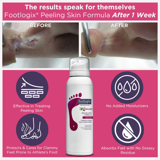 Foot Logix - Peeling Skin Formula