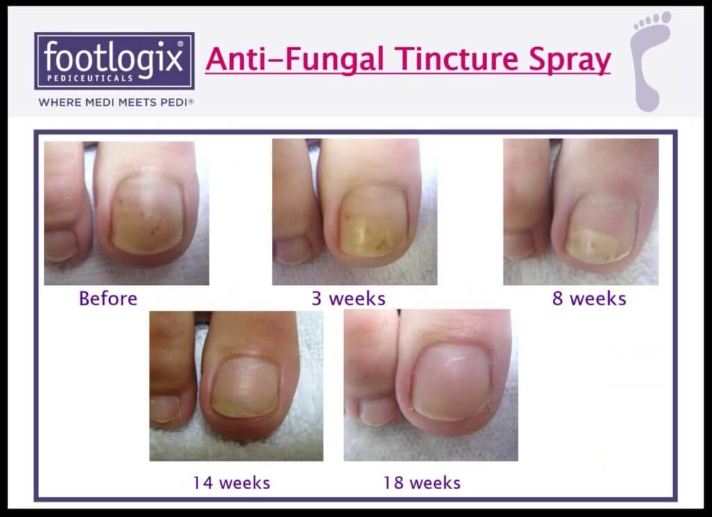 Foot Logix - Nail Tincture Spray