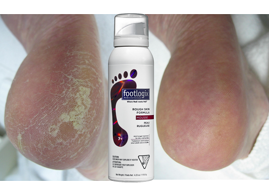 Foot Logix - Rough Skin Formula