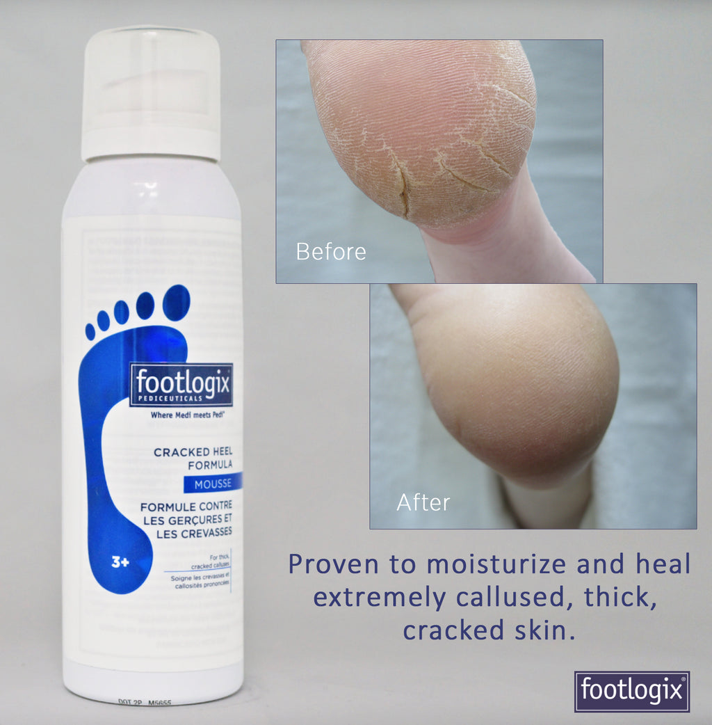 Foot Logix - Cracked Heel Formula