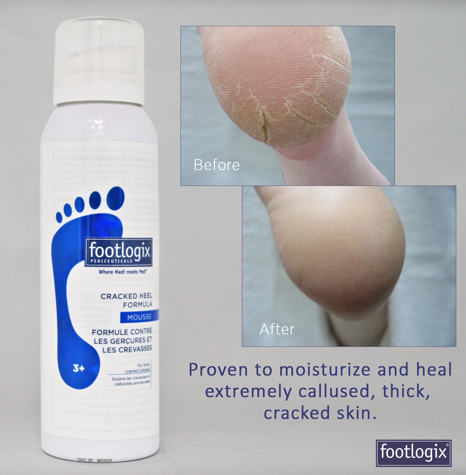Foot Logix - Cracked Heel Formula